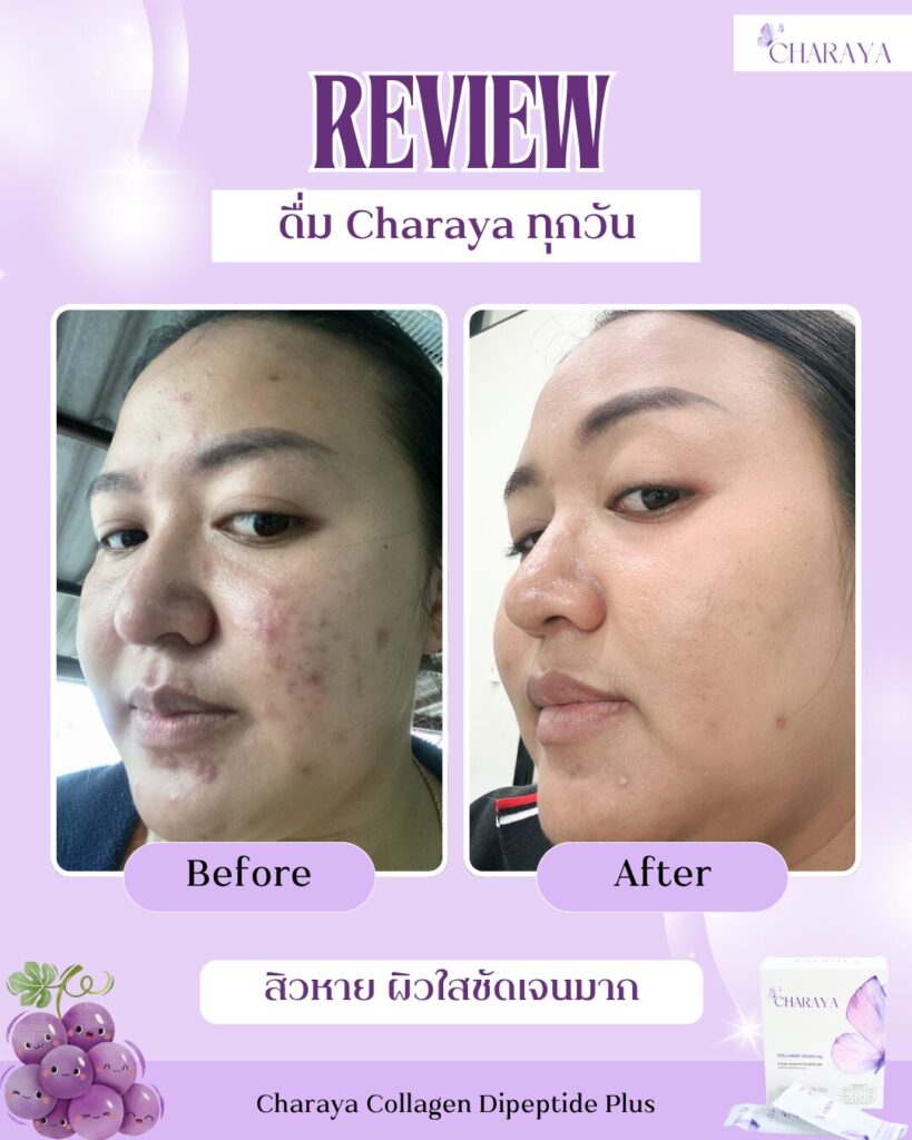 คอลลาเจน,คอลลาเจนผิวใส,collagen,คอลลาเจนลดใต้ตาคล้ำ,charaya